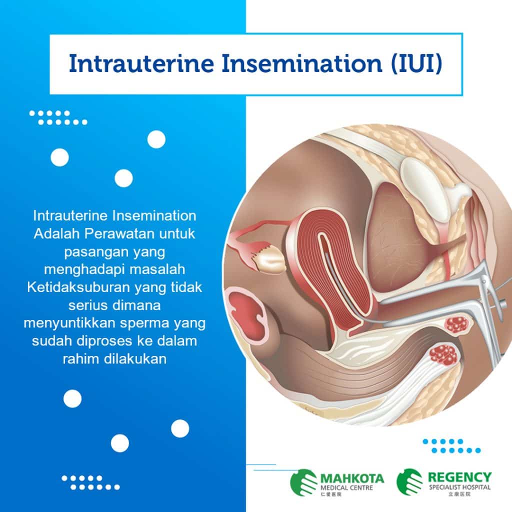 Perbedaan IUI, IVF, & ICSI Sebagai Solusi Mengatasi Ketidaksuburan 1