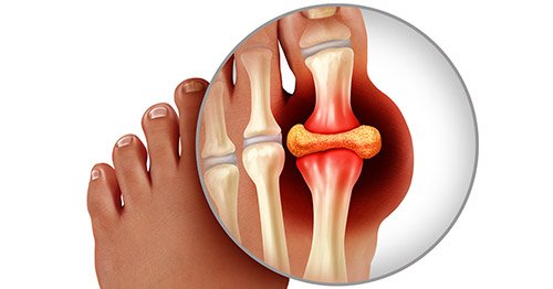 Cara dokter malaysia mengobati asam urat