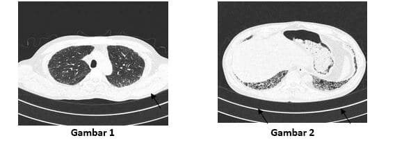 Fibrosis Paru Idiopatik